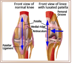 What is a Floating Kneecap?